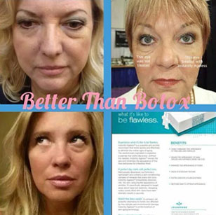 Better Than Botox